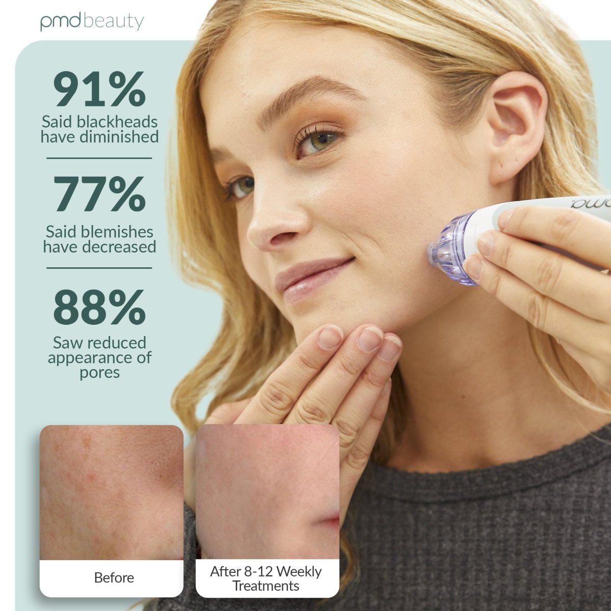 Kyla Microdermabrasion Device Smooth Glow Exfoliating Suction