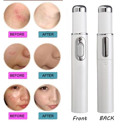 Leonor Blue Light Acne Wand Clear Skin, Calm Pores, Portable