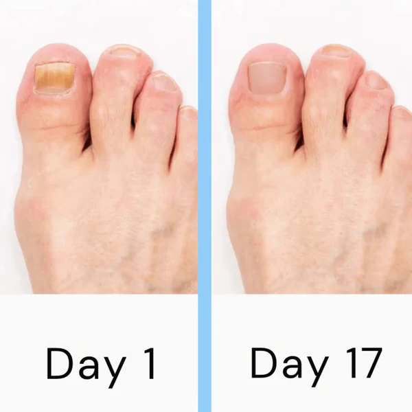 Angelica Nail Laser Therapy Device Clearer Nails At Home